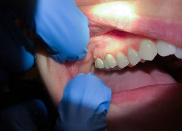 Best Emergency Broken Tooth Repair in Hargill, TX